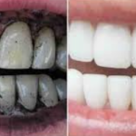 SK Ummikkari Activated Charcoal Teeth Whitening Powder from Rice Husk with Salt, 200g