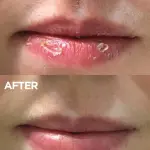 RIGHTPICK LIPBALM 10GM Strawberry Flavour unique moisture for chapped or dry lip